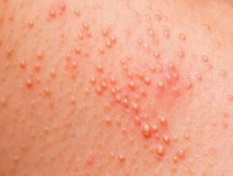 Hogyan lehet meghatározni az ember helminthiasist, Rovarok és élősködők okozta bőrbetegségek