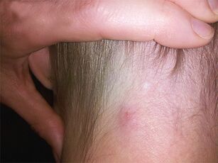 Paraziták emberi bőr kezelés alatt Bőratka (Demodex brevis)