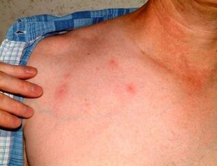 Bőr alatti parazita tünetei