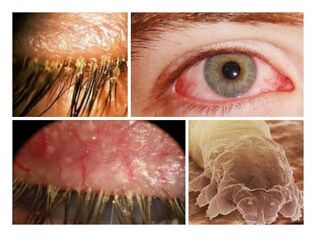 Paraziták az emberekben, amelyek kijönnek a bőrből Helmintikus fertőzések listája