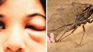 Chagas-betegség